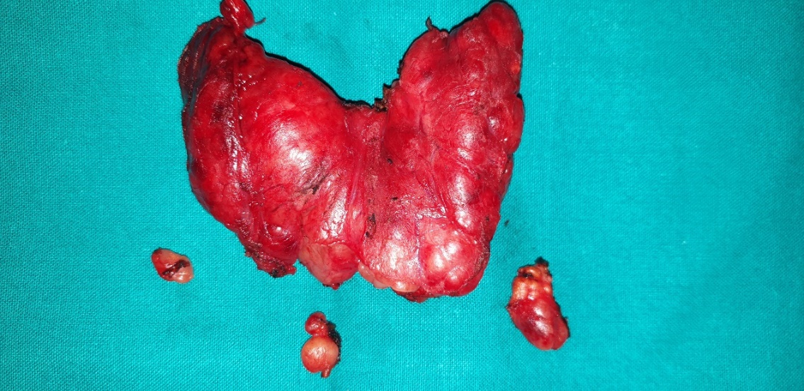 Total thyroidectomy specimen together with lymph node sampling