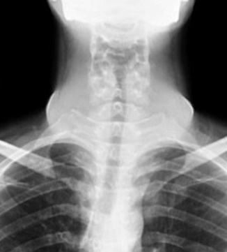 Chest X-Ray showed diffuse swelling in the neck with patent none deviated trachea