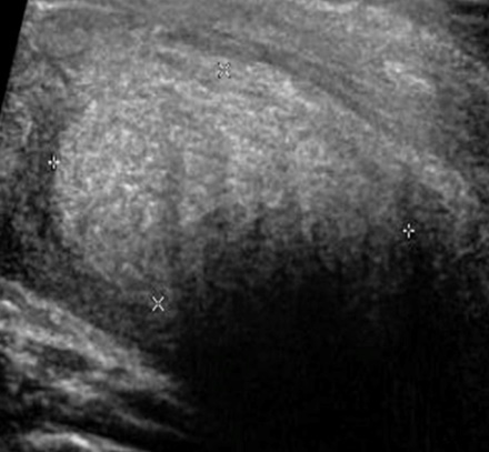 Ultrasound scan of the neck revealed heterogeneous parenchymal echotexture of both the thyroid lobes with multiple heterogeneous nodules seen