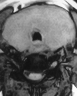 CT-Scan neck showed diffusely enlarged thyroid gland with heterogeneous enhancement but no calcification
