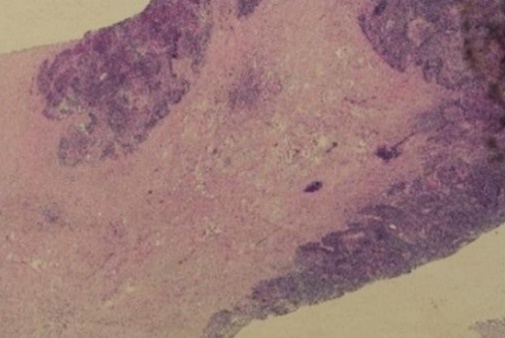 Fibrosis and inflammation are evident