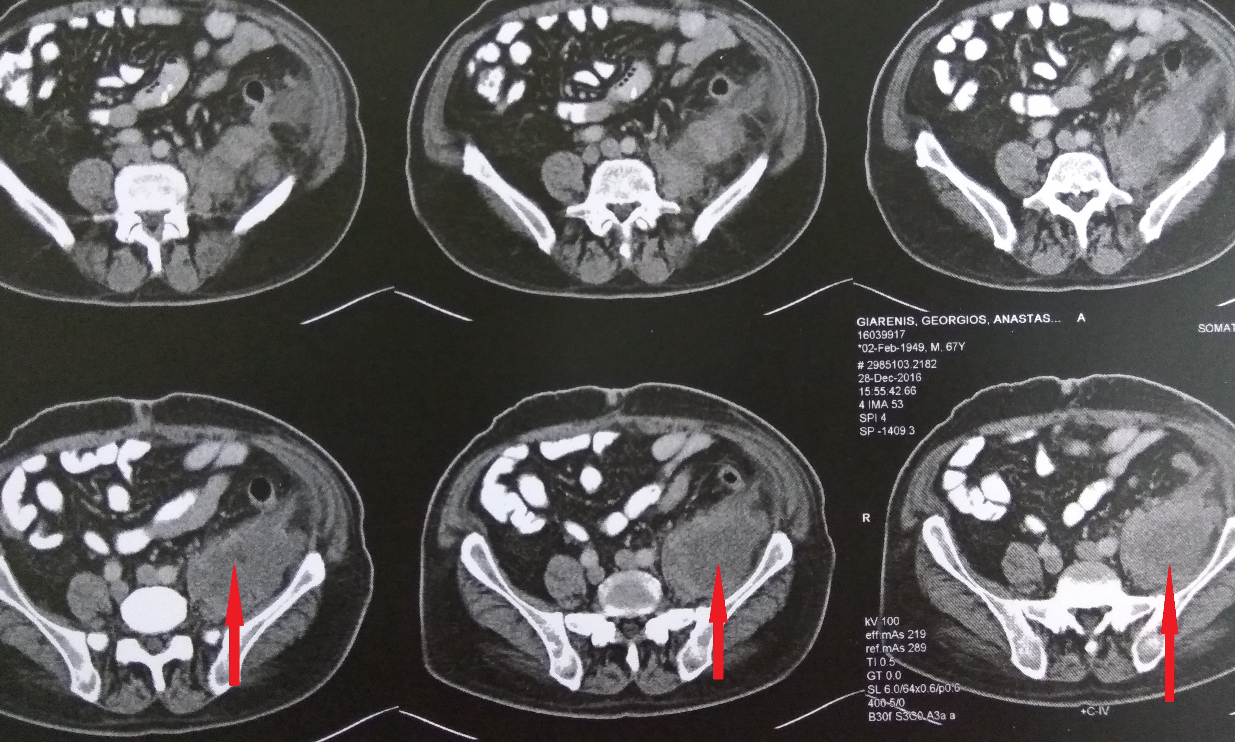 Αξονική τομογραφία κοιλίας. Φεβρουάριος 2017. Εμφανίζεται η υποτροπή του οπισθοπεριτοναϊκού αγγειοσαρκώματος (κόκκινα βέλη)