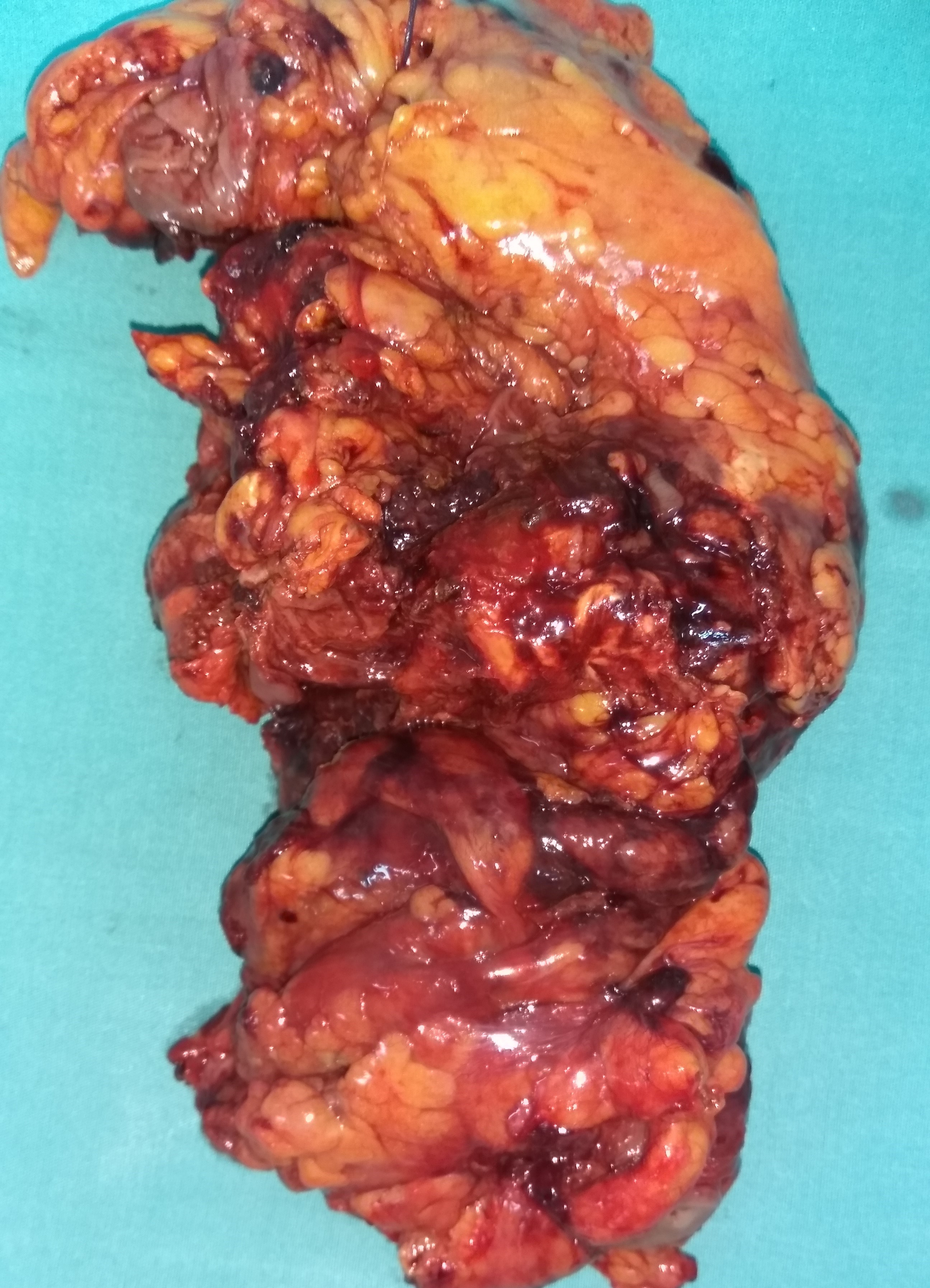 Παρασκεύασμα αριστερής κολεκτομής