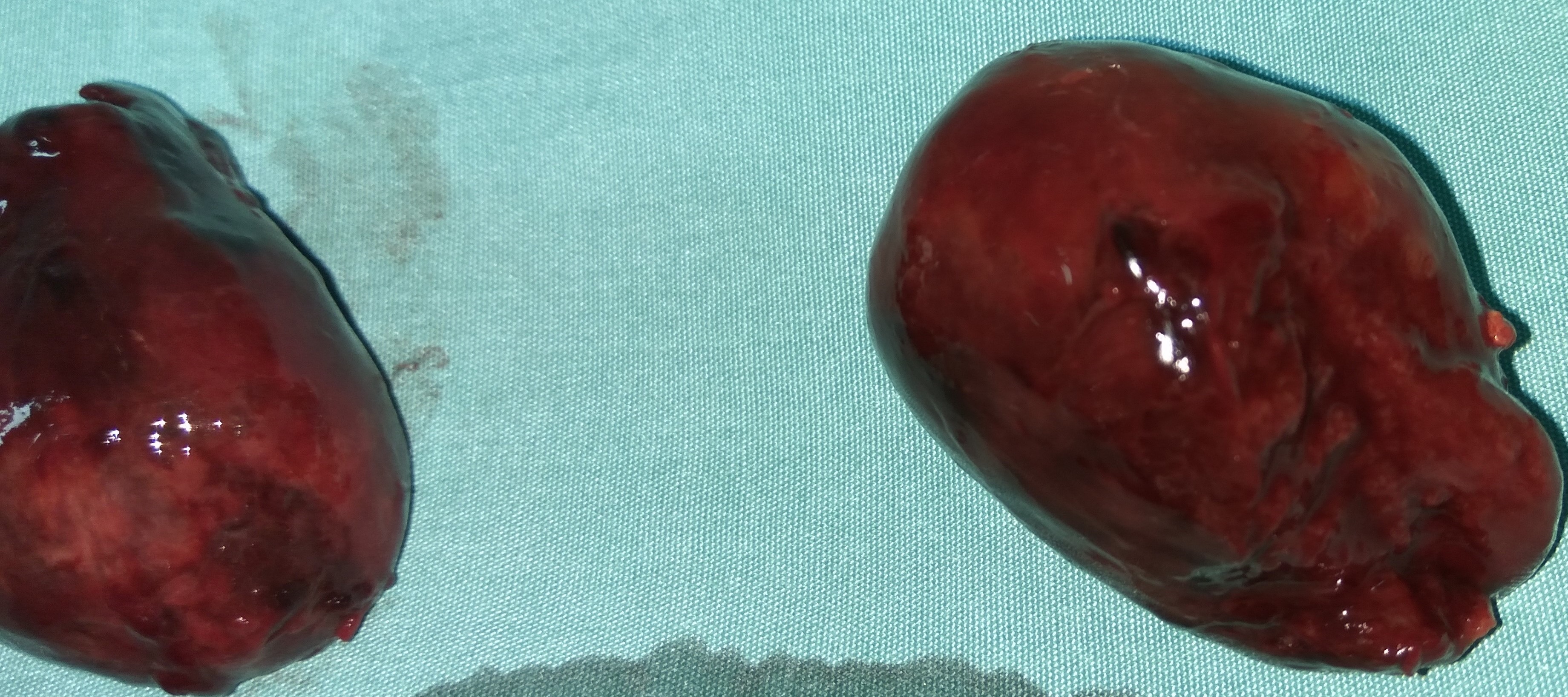 Εκταμέν μεταστάσεις λεπτού εντέρου