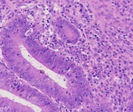 Υψηλά διαφοροποιημένο αδενοκαρκίνωμα ορθού