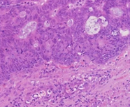 Μέτρια διαφοροποιημένο αδενοκαρκίνωμα ορθού