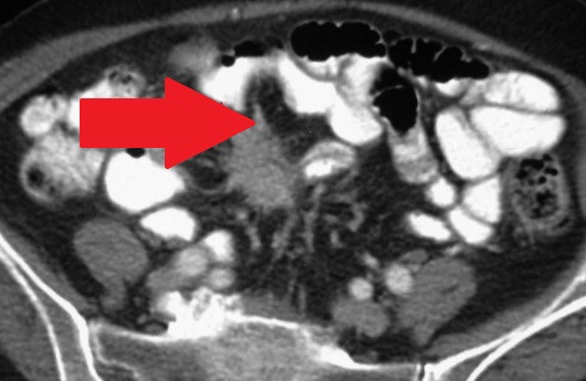 Abdominal CT Scan. Mass in the mesentery