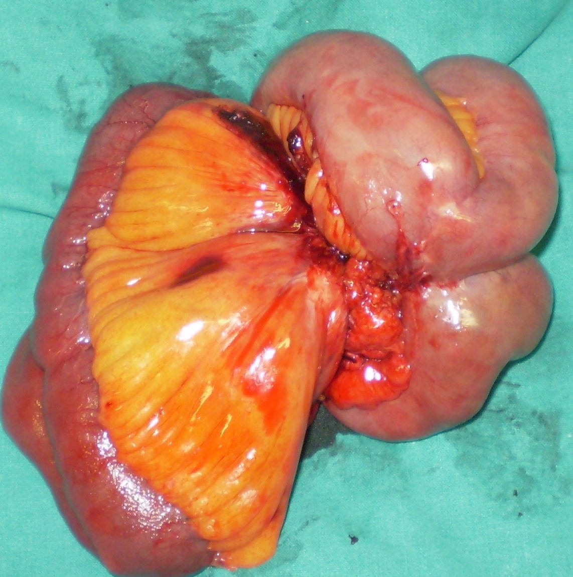 Enterectomy specimen. Mesenteric NET