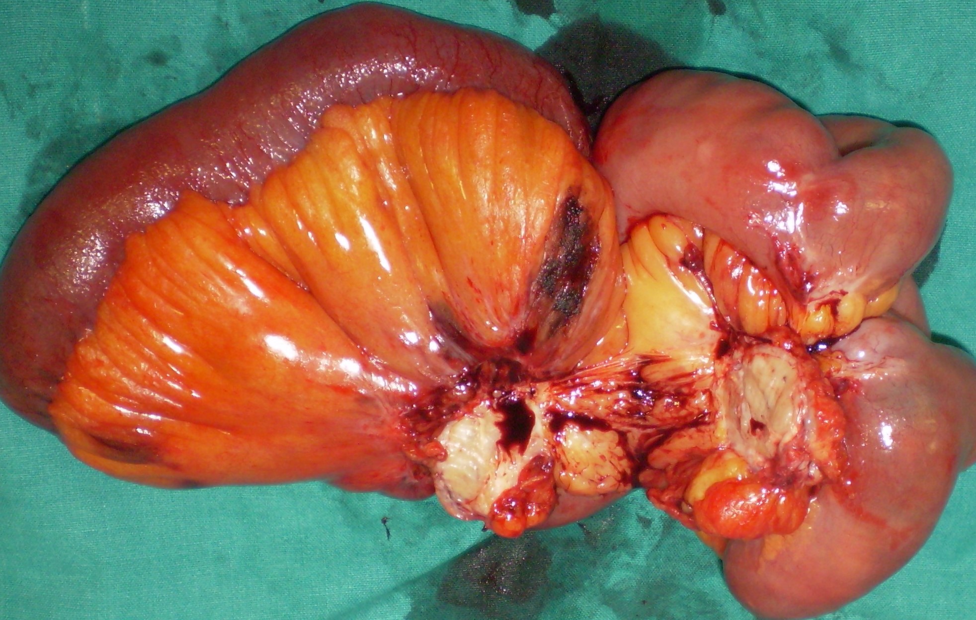 Enterectomy specimen. Mesenteric NET