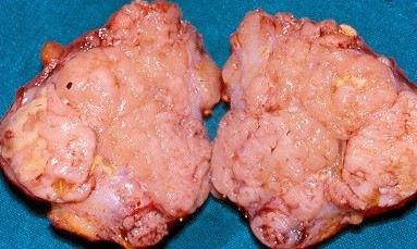 Adrenalectomy specimen