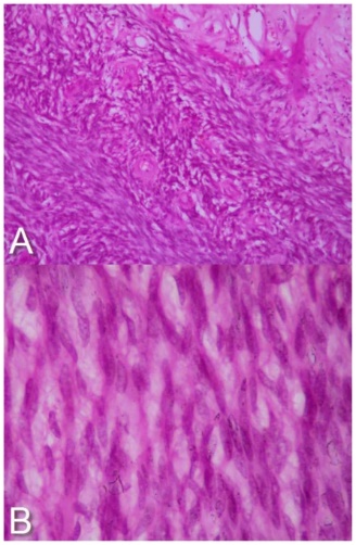 A: Palisading of the nuclei with hyaline thickening of the blood vessel. B: Microphotograph showing tumor composed of fibrohyalinized collagenous tissue with overlying Schwann cells in hyper cellular areas