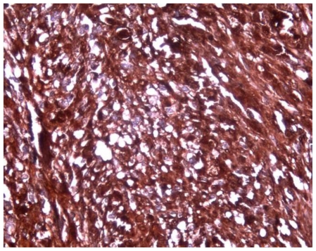 Microphotograph showing S-100 immunoreactivity in the tumor cells