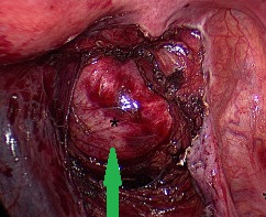 Retrorectal - presacral tumor