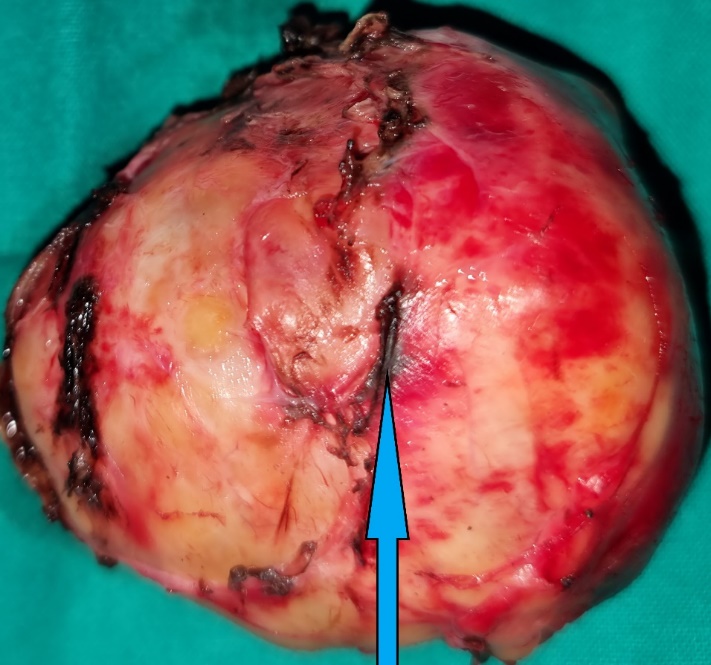 Excised presacral Schwannoma