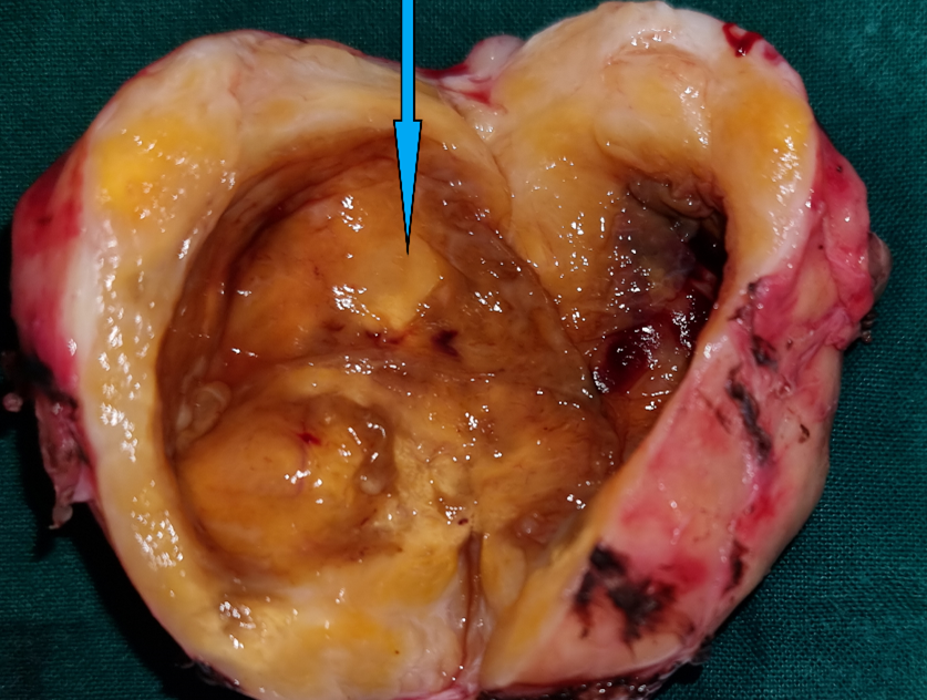 Specimen opened. The cystic nature of the tumor is evident