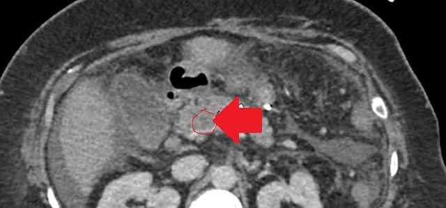 Portal vein thrombosis