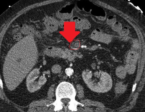 Superior mesenteric vein thrombosis