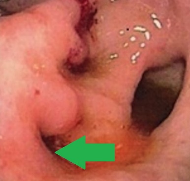 Upper gastrointestinal endoscopy showing a grossly deformed duodenal bulb. A steady trickle of bile was also seen to come from a slit-like orifice on the anterior duodenal wall suggestive of biliary duodenal fistula (green arrow)
