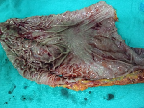 Cholecystectomy specimen