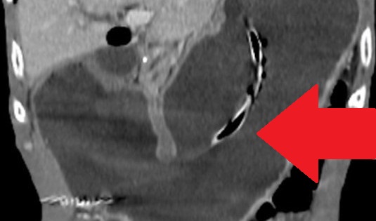 Contrast-enhanced CT of the abdomen, revealed a grossly distended stomach with mild diffuse thickening of its wall (red arrow)
