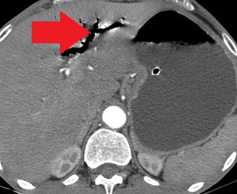 Contrast-enhanced CT of the abdomen, revealing air in intrahepatic biliary tree (pneumobilia) (red arrow)
