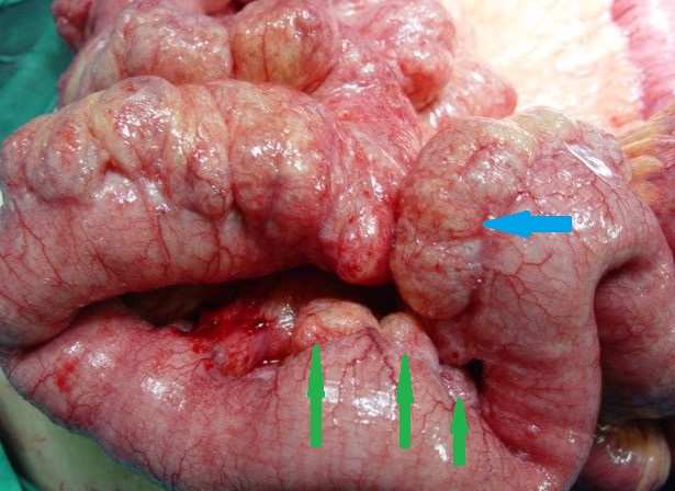 Operative view of pneumatosis intestinalis. Blue arrow - Pneumatosis. Green arrows - Diverticula