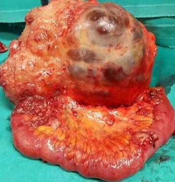 Παρασκεύασμα εκτεταμένης δεξιάς ημικολεκτομής (Ευγενική παραχώρηση Dr. V. Penopoulos)