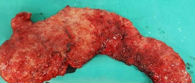 Τμήμα του παρασκευάσματος περιτονεκτομής (Ευγενική παραχώρηση Dr. V. Penopoulos)