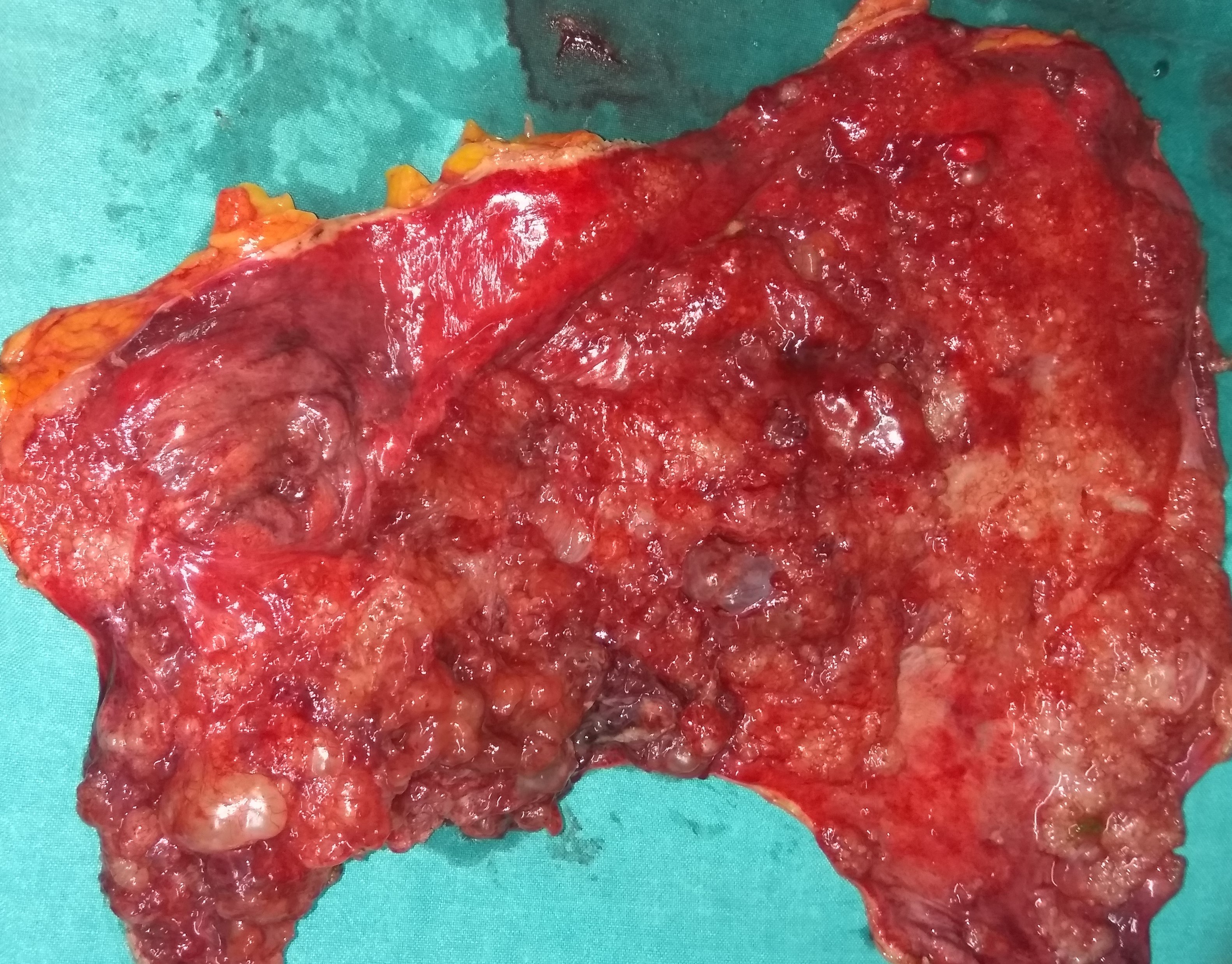 Εκταμέν μείζον επίπλουν (Ευγενική παραχώρηση Dr. V. Penopoulos)