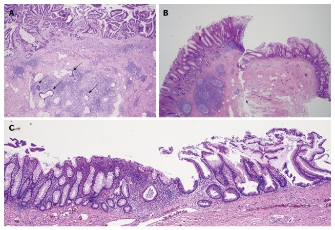 Εικόνες ιστοπαθολογίας του ψευδομυξώματος (Ευγενική παραχώρηση Dr. V. Penopoulos)