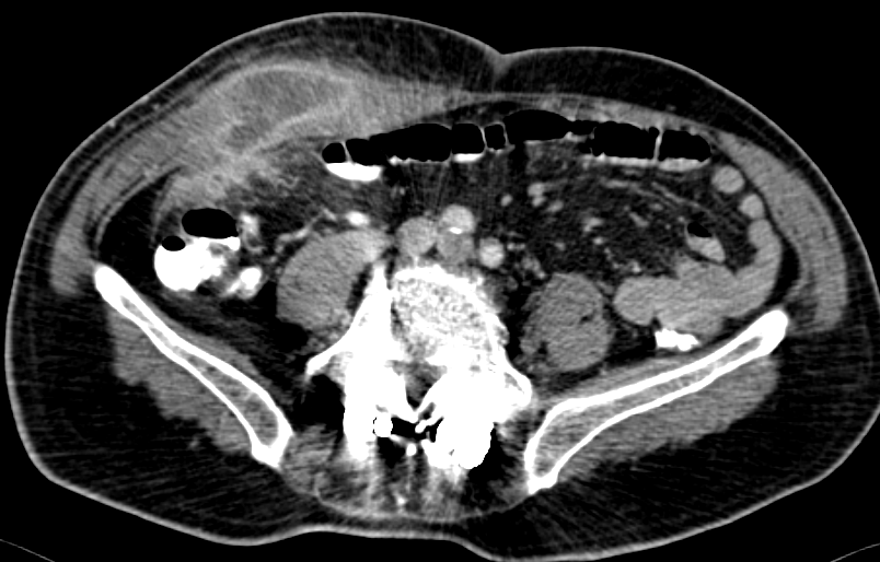 Εικόνες CT κοιλίας, που δείχνουν κυστικού τύπου βλάβη, μεταξύ ήπατος και ηπατικής καμπής του κόλου, σε επαφή με το εξωτερικό στρώμα του εντέρου, με πεπαχυσμένο τοίχωμα και χαμηλής πυκνότητας κέντρο (Ευγενική παραχώρηση Dr. V. Penopoulos)