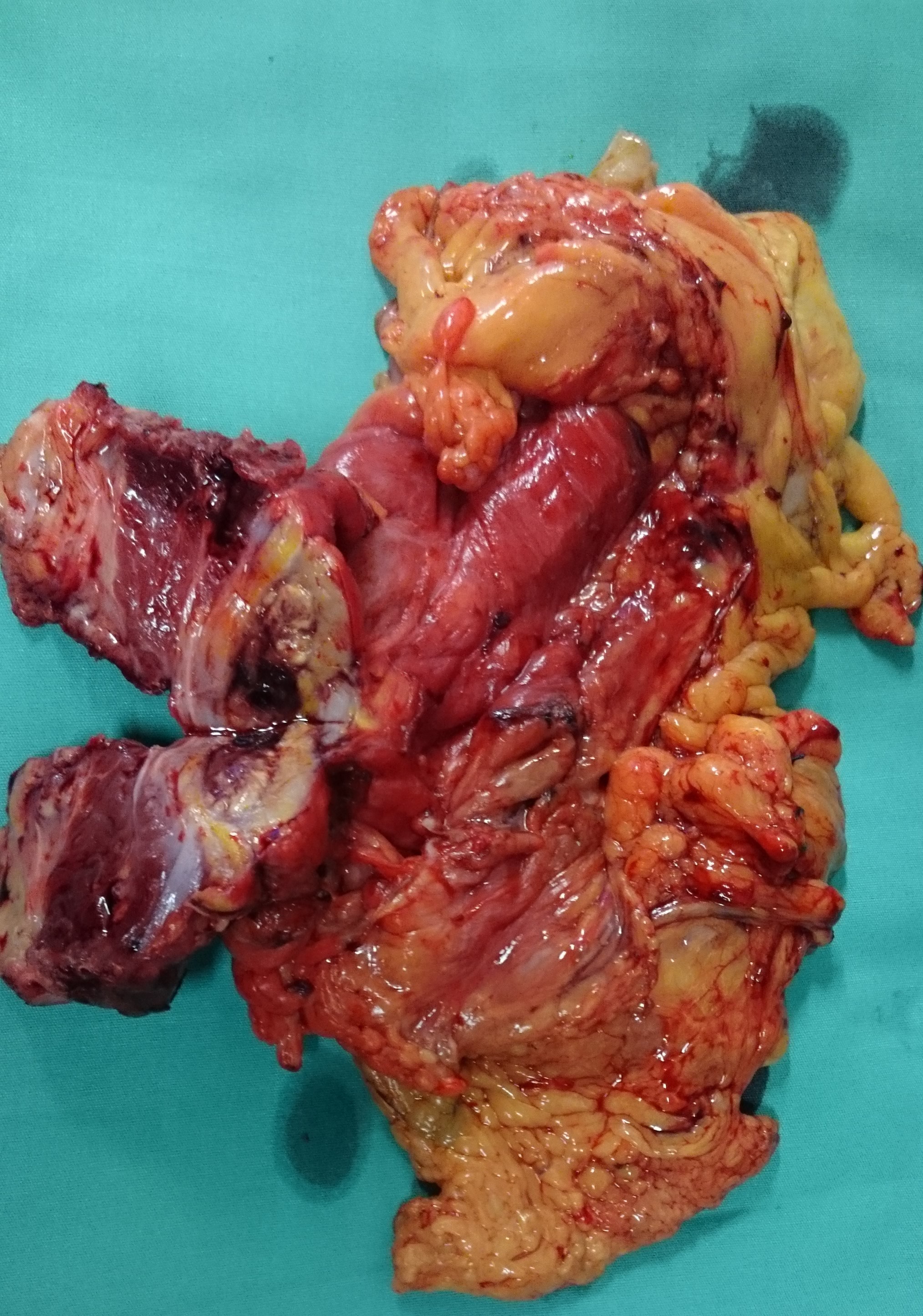 Η εκταμένη μάζα μαζί με το δεξιό ημικόλο και το κοιλιακό τοίχωμα (Ευγενική παραχώρηση Dr. V. Penopoulos)