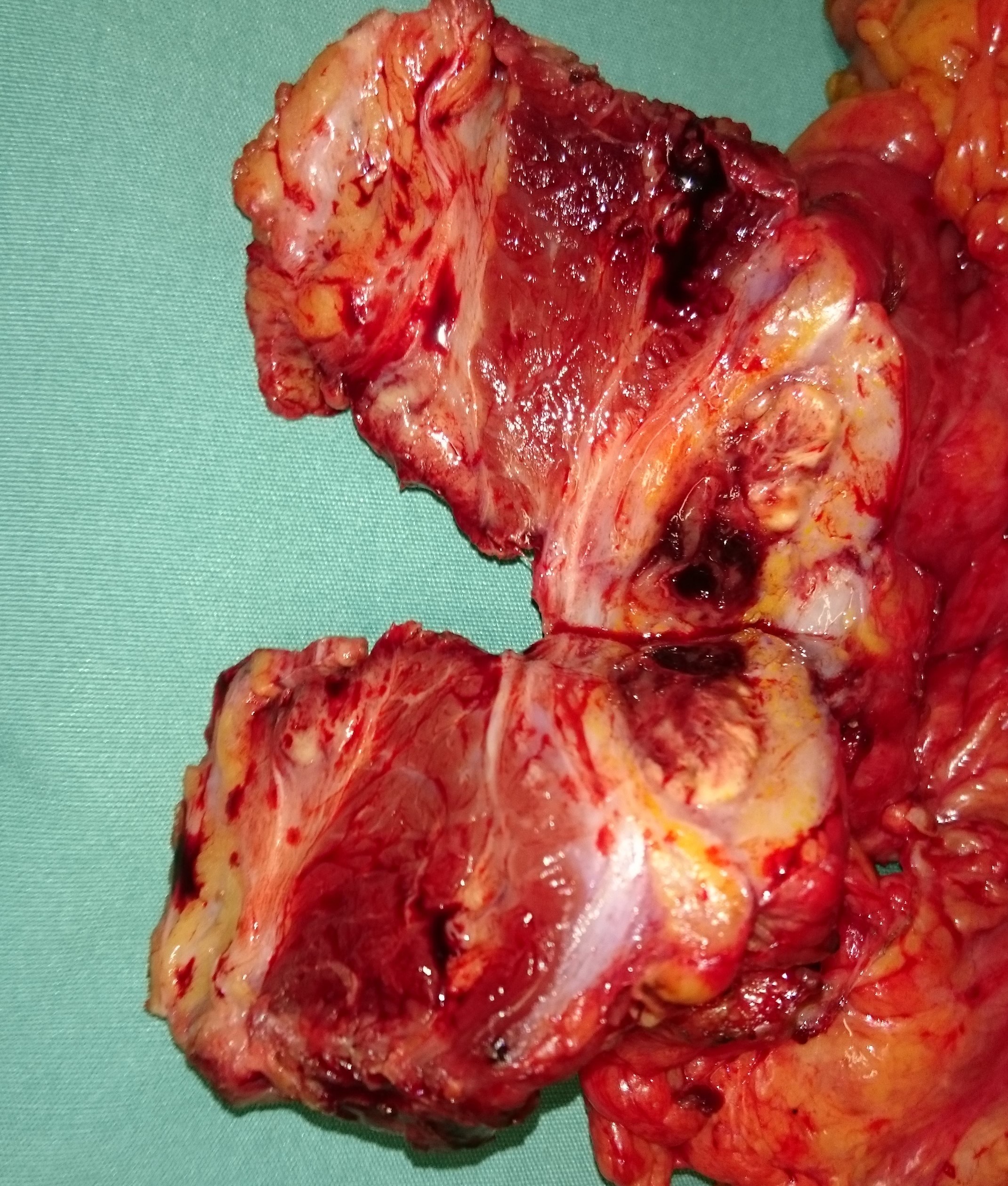 Το παρασκεύασμα διατμημένο από τον παθολογοανατόμο (Ευγενική παραχώρηση Dr. V. Penopoulos)