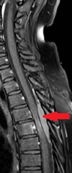 MRI σπονδυλικής στήλης που δείχνει εξωσκληρίδια συμπίεση στο επίπεδο Θ8 (Ευγενική παραχώρηση Dr. V. Penopoulos).