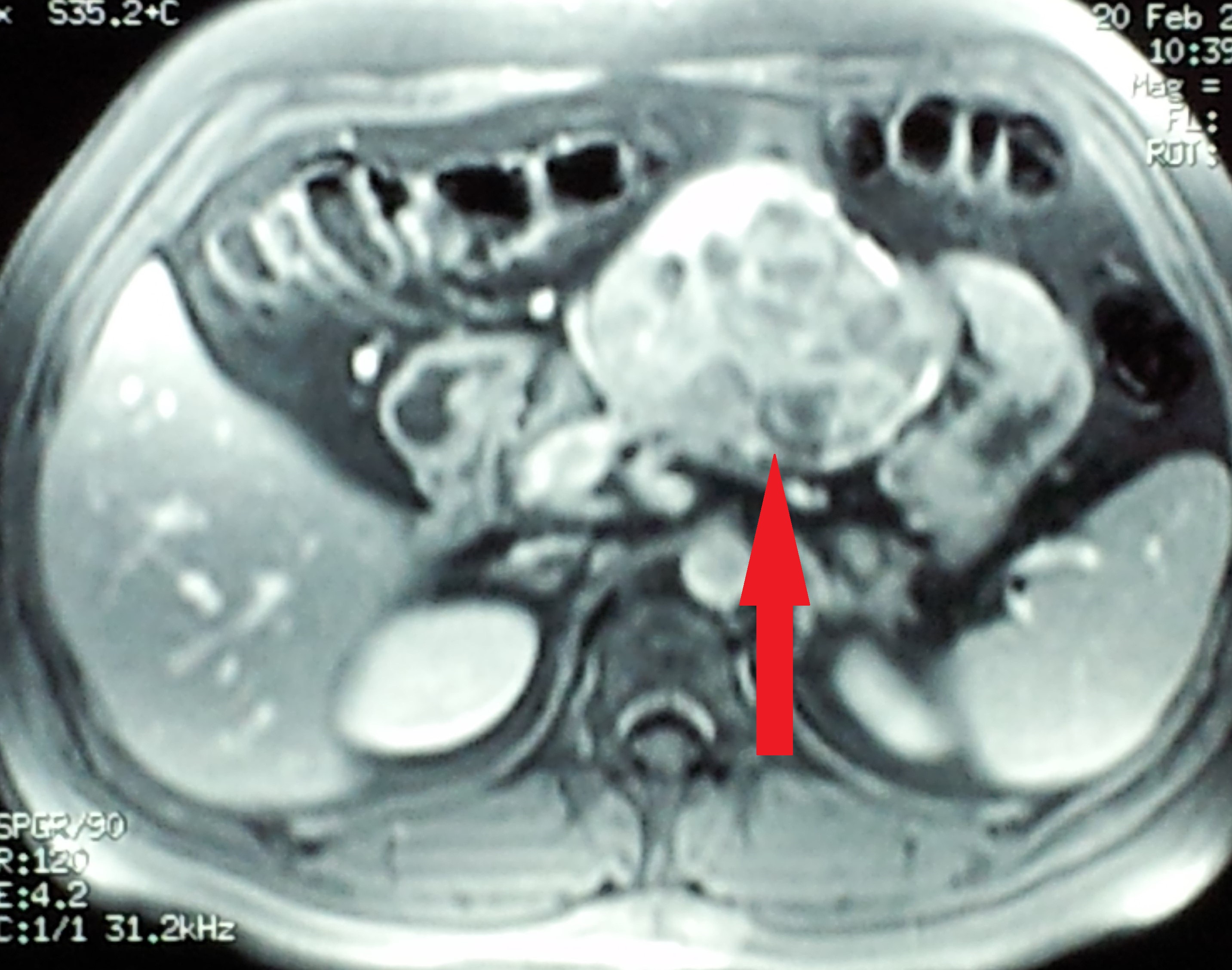 MRI κοιλίας που δείχνει το ευμεγέθες παραγαγγλίωμα στη ρίζα του μεσεντερίου (Ευγενική παραχώρηση Dr. V. Penopoulos)