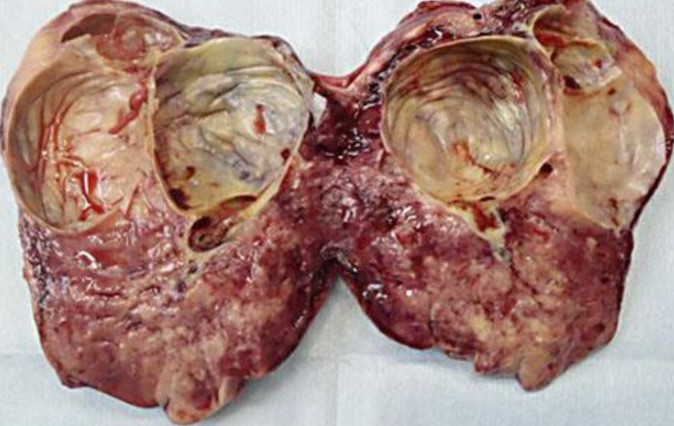 Τομή του παραγαγγλιώματος (Ευγενική παραχώρηση Dr. V. Penopoulos)