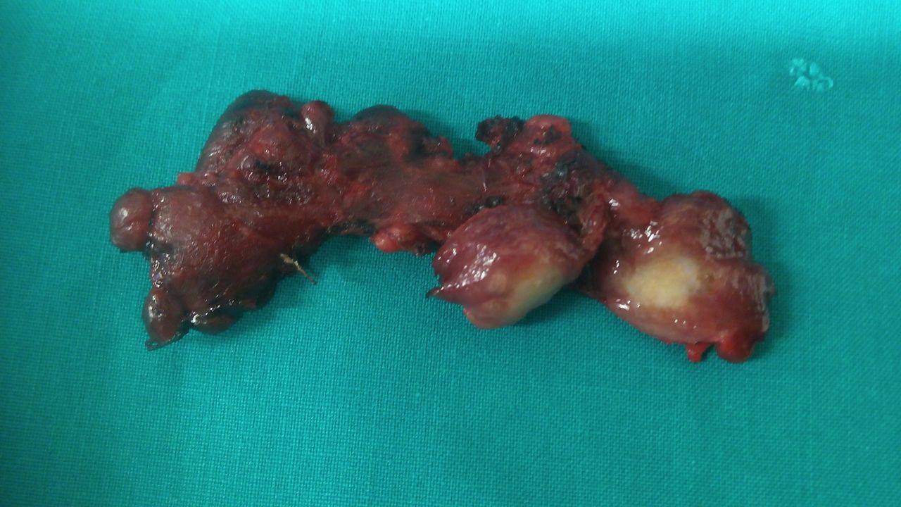 Postpartum thyroiditis and papillary thyroid carcinoma