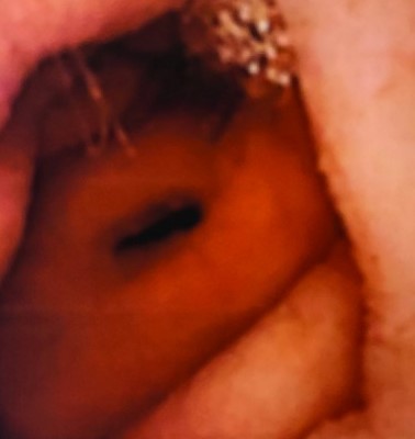 Εντερεκτομή. Πράσινο βέλος: εξέλκωση βλεννογόνου. Μπλε βέλος: διάφραγμα (Ευγενική παραχώρηση Dr. V. Penopoulos)