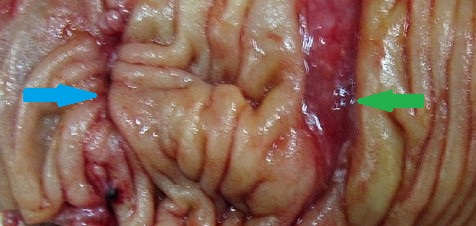 Παγιδευμένη κάψουλα (Ευγενική παραχώρηση Dr. V. Penopoulos)