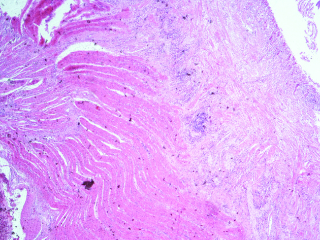 Μικροσκοπική τομή στένωσης που δείχνει υπερτροφική muscularis propria με κάθετα προσανατολισμένες μυϊκές ίνες και υποβλεννογόνια ίνωση (Ευγενική παραχώρηση Dr. V. Penopoulos)