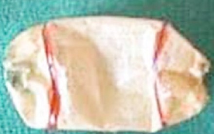 Μικροσκοπική τομή στένωσης που δείχνει υπερτροφική muscularis propria με κάθετα προσανατολισμένες μυϊκές ίνες και υποβλεννογόνια ίνωση (Ευγενική παραχώρηση Dr. V. Penopoulos)