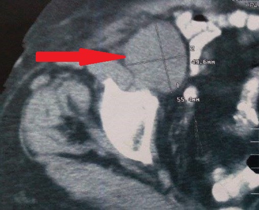 Εκτμηθέντες λεμφαδένες (Ευγενική παραχώρηση Dr. V. Penopoulos)