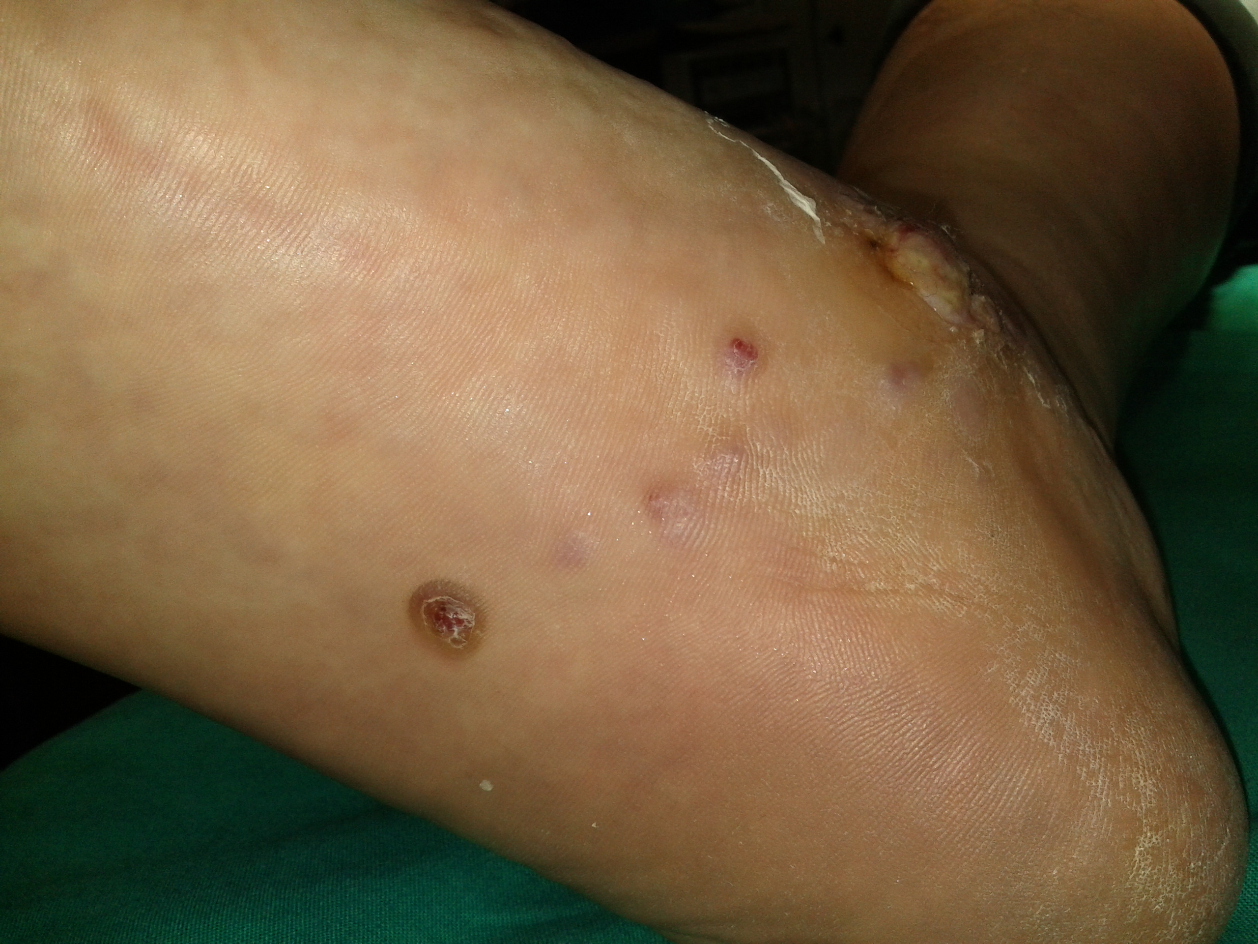 Non ulcerated Kaposi's Sarcoma lesions on the plantar aspect of the right foot (Courtesy Dr. V. Penopoulos)