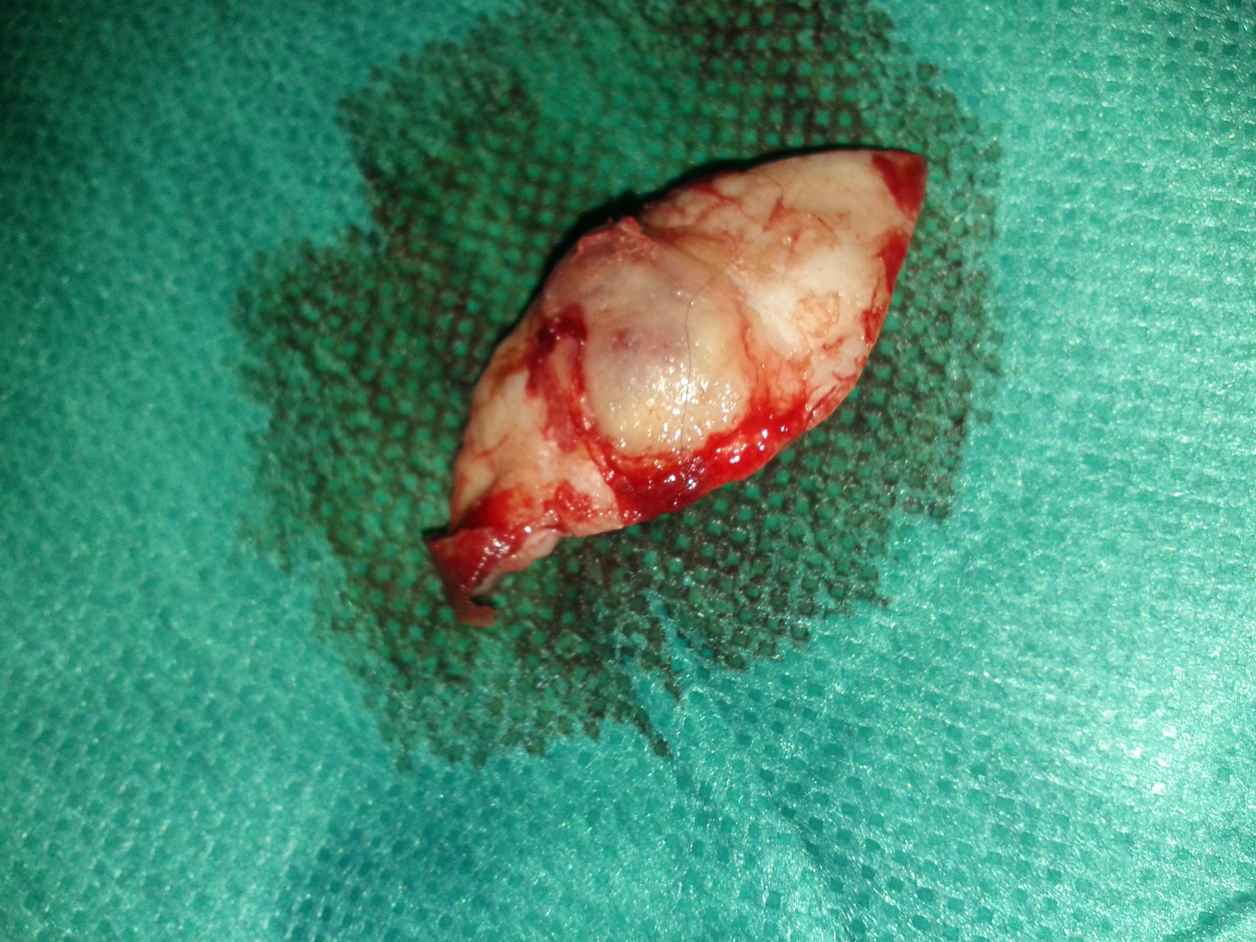 Excised ulcerative Kaposi lesion and microscopy view (Courtesy Dr. V. Penopoulos)