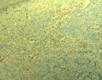Excised ulcerative Kaposi lesion and microscopy view (Courtesy Dr. V. Penopoulos)