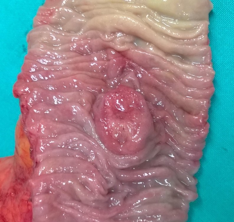 Gross appearance of the resected tumour (Courtesy Dr. V. Penopoulos)