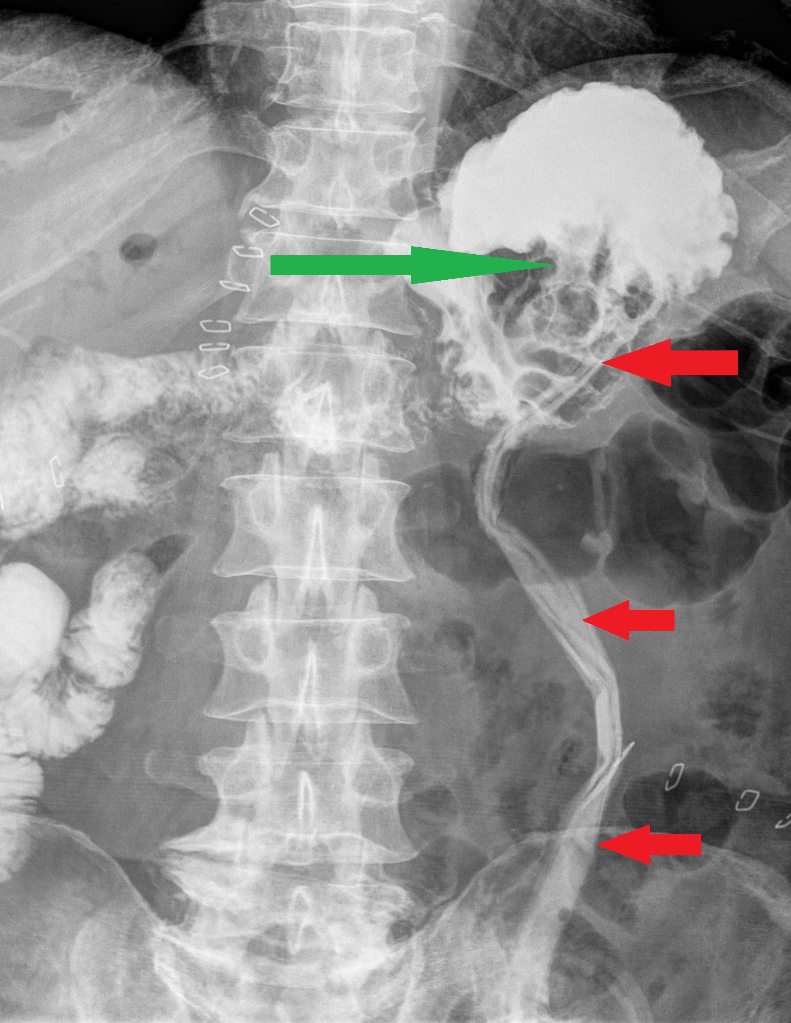 Gastrografin swallow pass . The intragastric site of the drainage tube is evident . The protruding mass in the stomach ( green arrow ) represents the pancreatic remnant pancreato-gastric anastomosis (Courtesy Dr. V. Penopoulos)