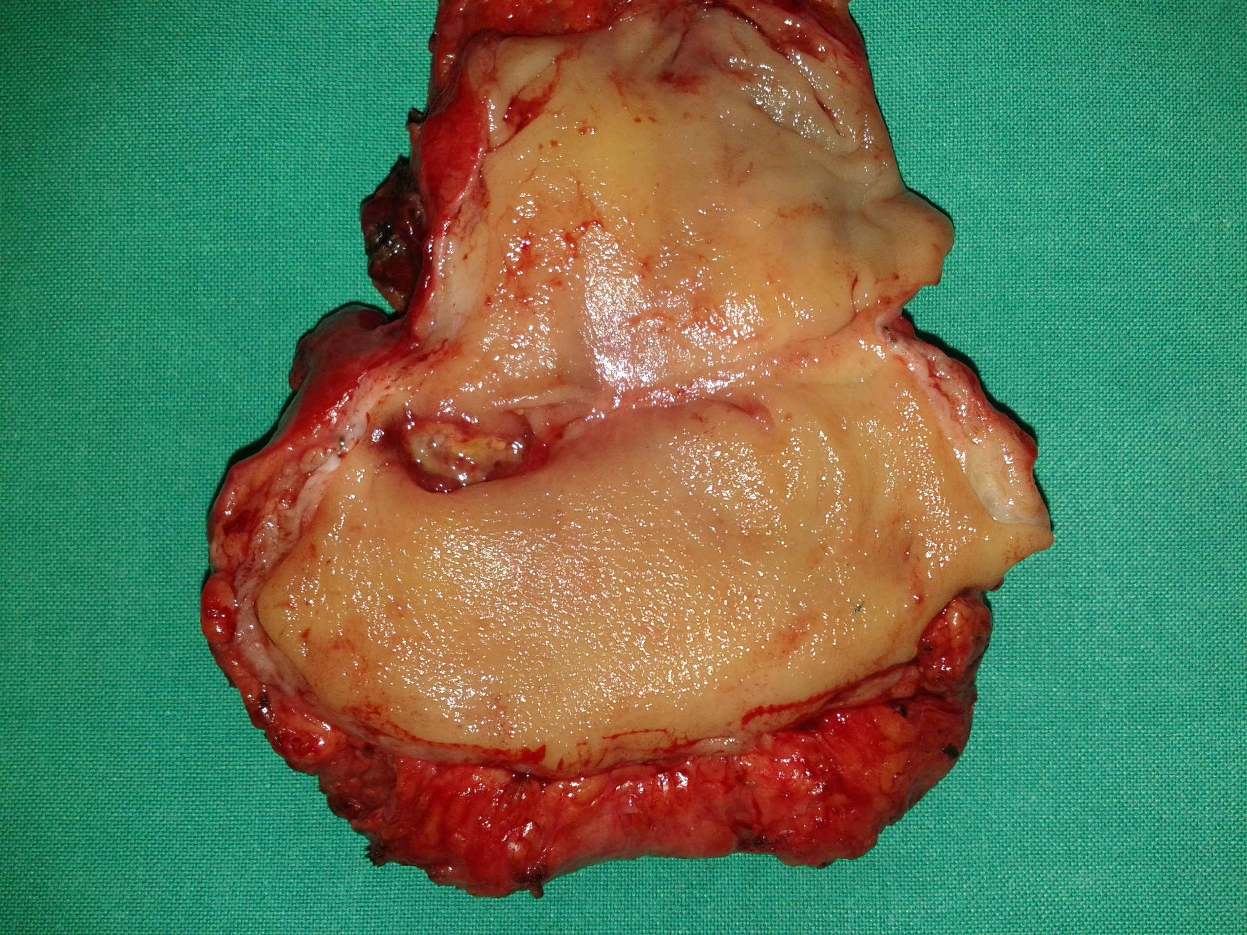 2015 : Πολύ χαμηλή πρόσθια εκτομή υποτροπής του ορθού (Ευγενική παραχώρηση Δρ. Β. Πενόπουλος)