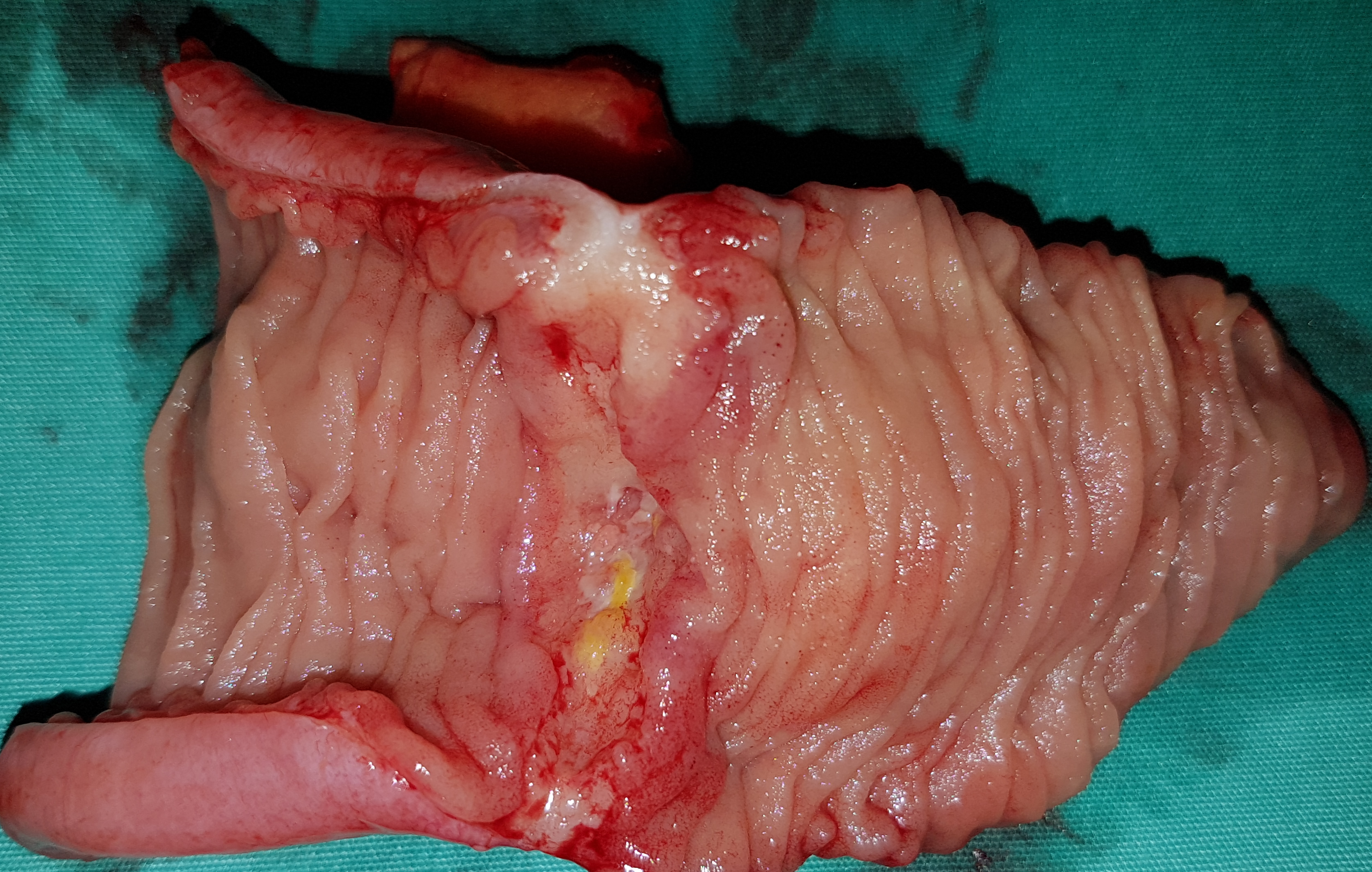 2017 : Μεταχρονικό αδενοκαρκίνωμα του ειλεού με μεταστάσεις στους λεμφαδένες (Ευγενική παραχώρηση Δρ. Β. Πενόπουλος)