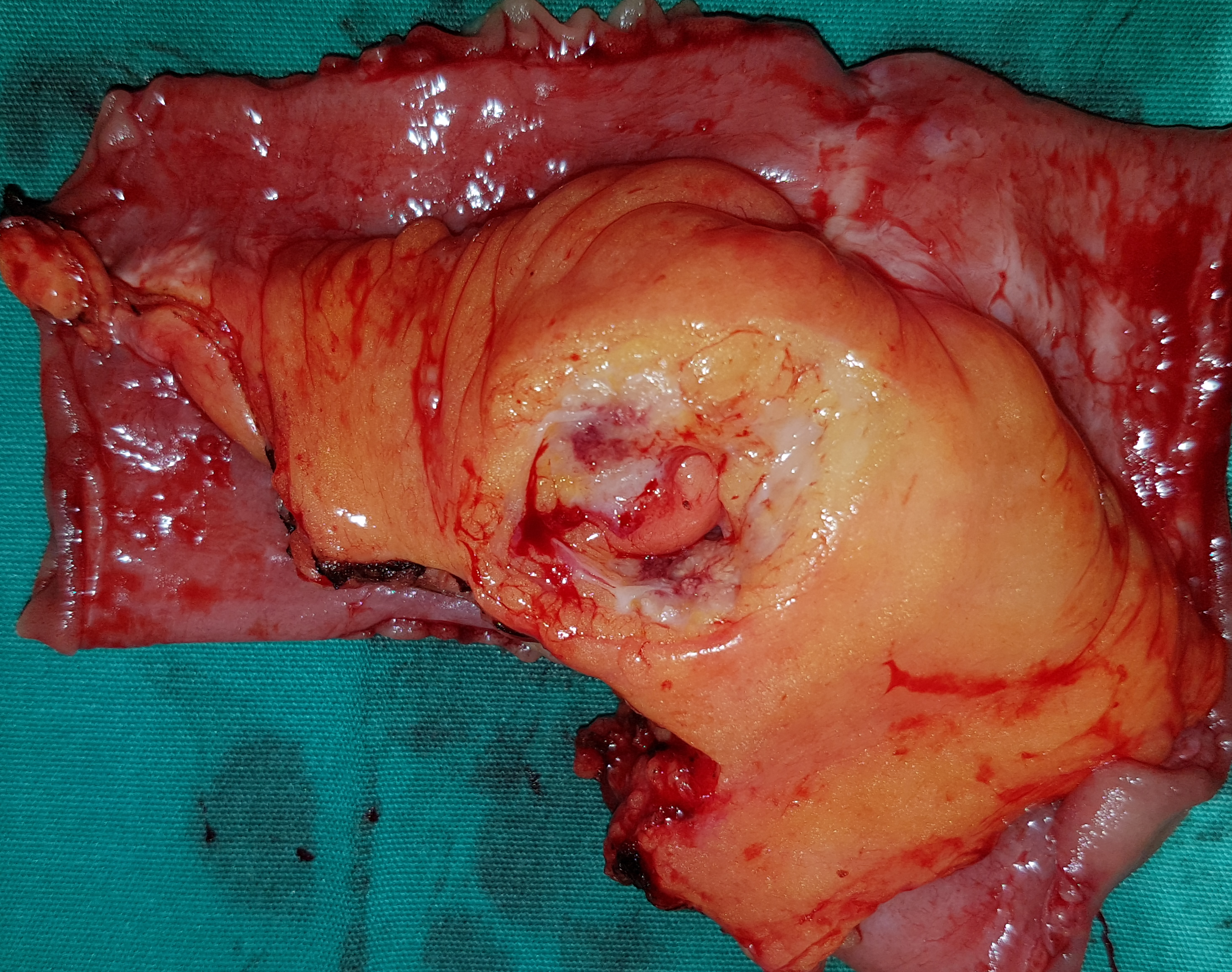 2017 : Μεταχρονικό αδενοκαρκίνωμα του ειλεού με μεταστάσεις στους λεμφαδένες (Ευγενική παραχώρηση Δρ. Β. Πενόπουλος)